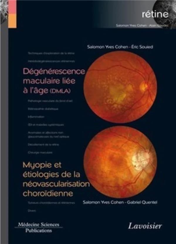 Dégénérescence maculaire liée à l'âge, DMLA