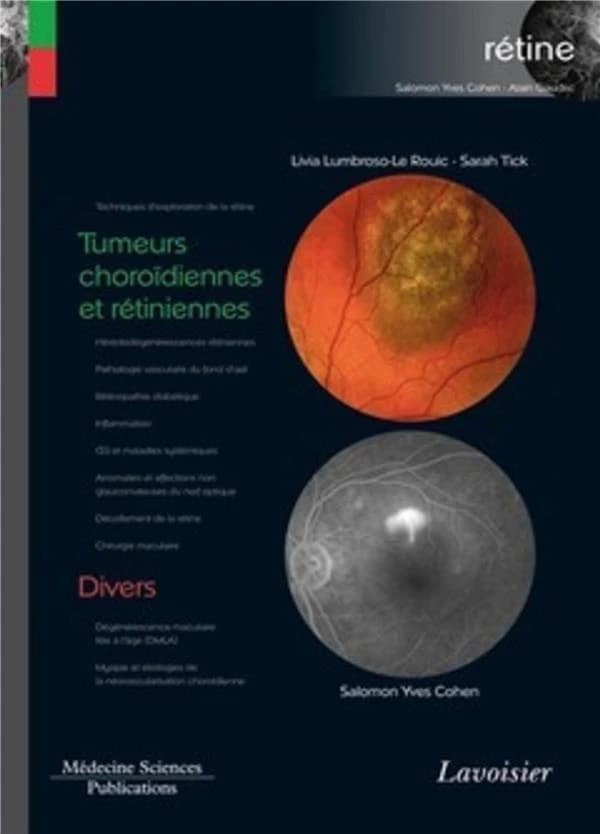 Tumeurs choroïdiennes et rétiniennes