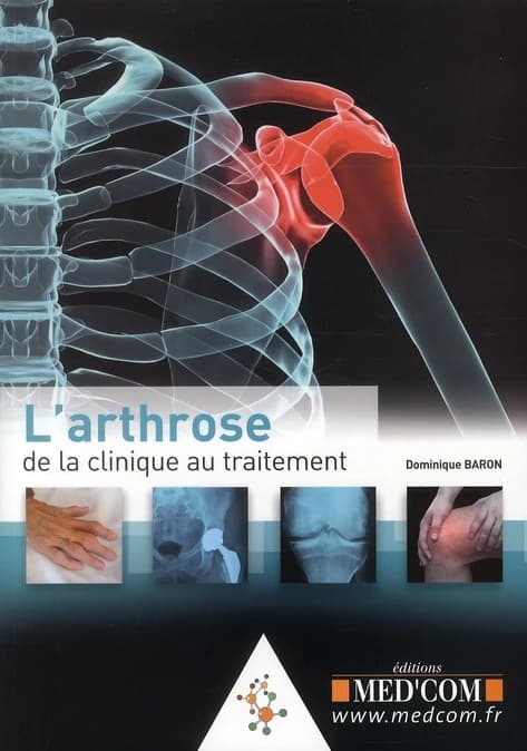 Arthrose : de la clinique au traitement