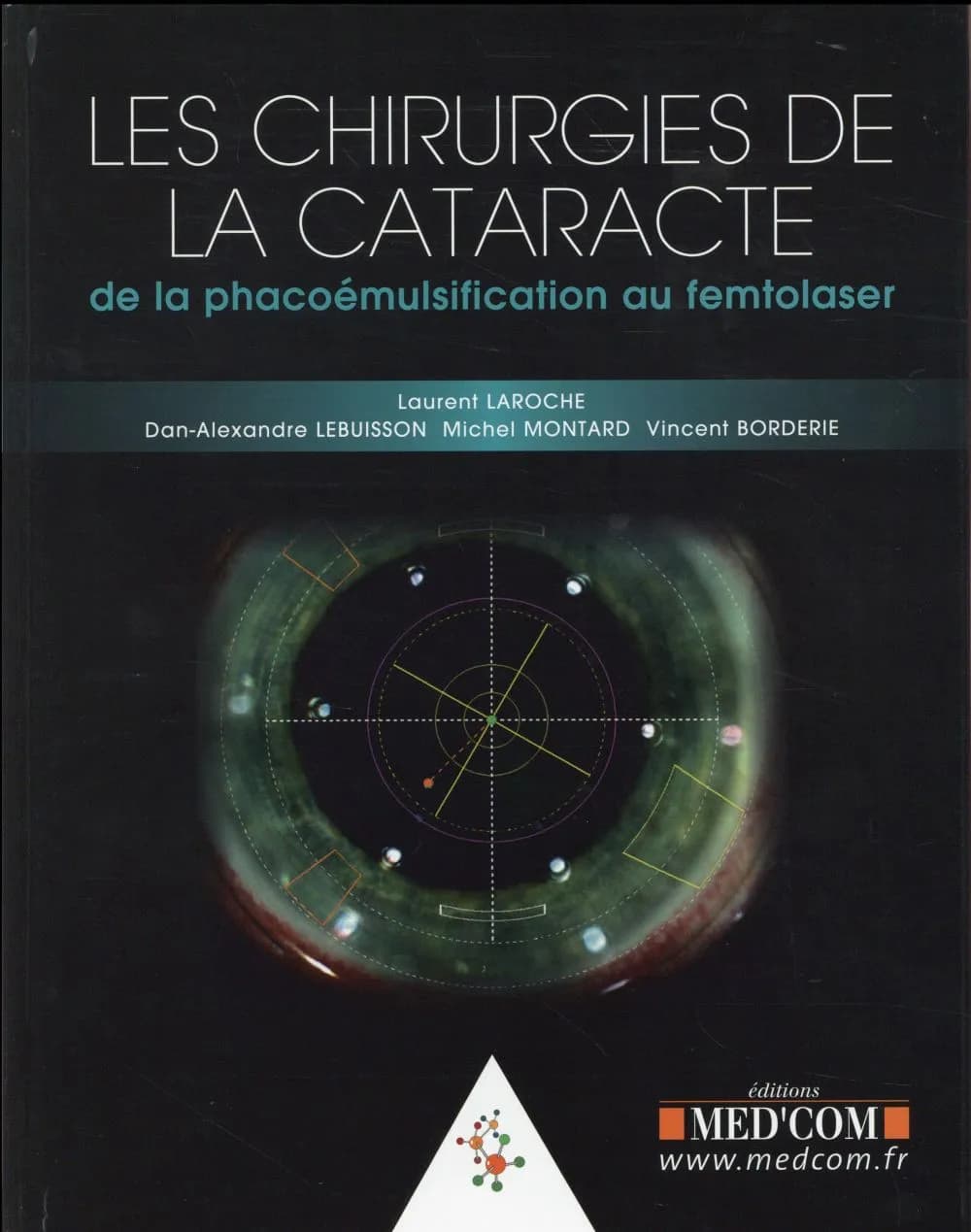 Les chirurgies de la cataracte : de la phacoémulsification au femtolaser