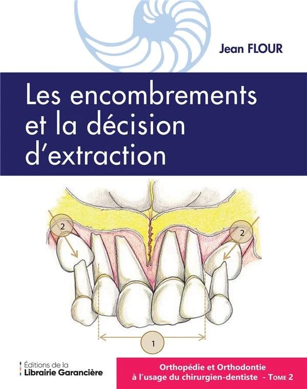 Les encombrements et la décision d'extraction