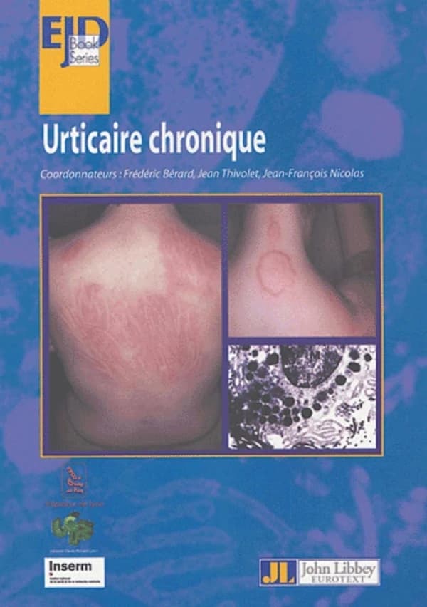Urticaire chronique