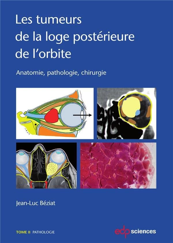 Les tumeurs de la loge postérieure de l'orbite : anatomie, pathologie, chirurgie. Tome II, Pathologie
