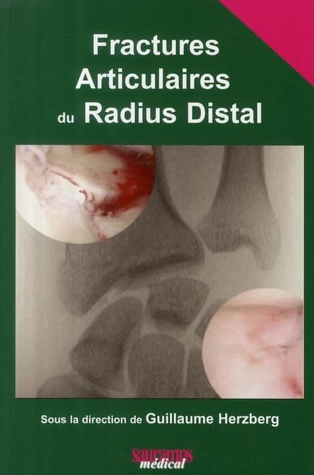 Fractures articulaires du radius distal