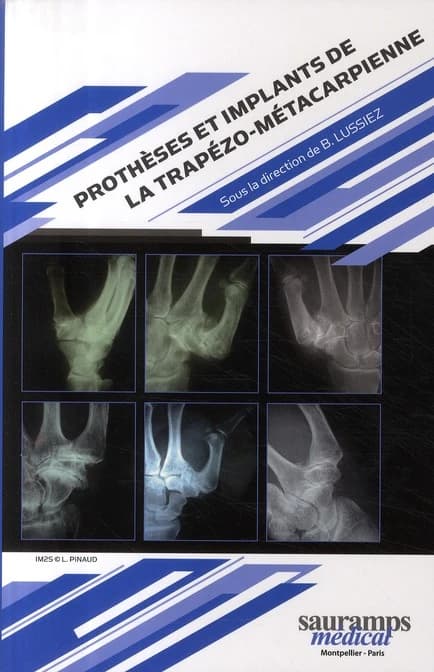 Prothèses et implants de la trapézo-métacarpienne