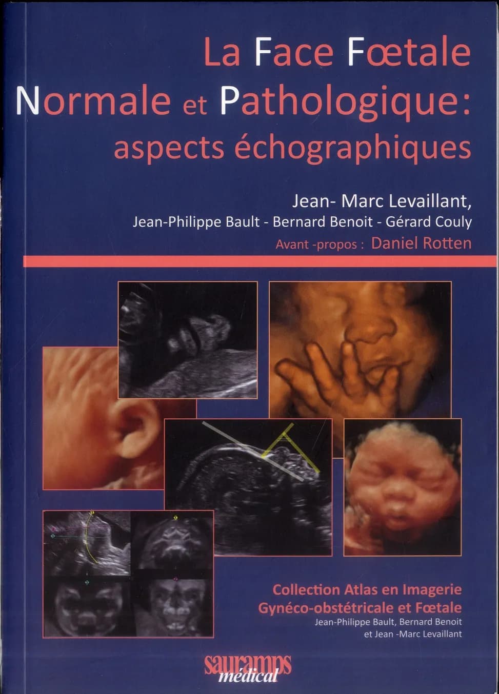 La face foetale normale et pathologique : aspects échographiques