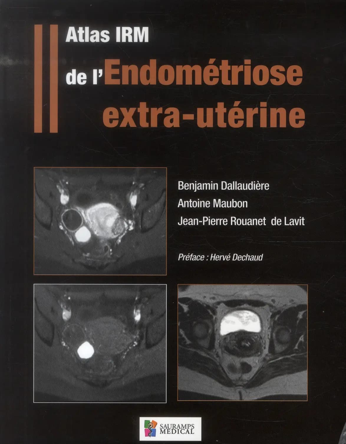 Atlas IRM de l'endométriose extra-utérine