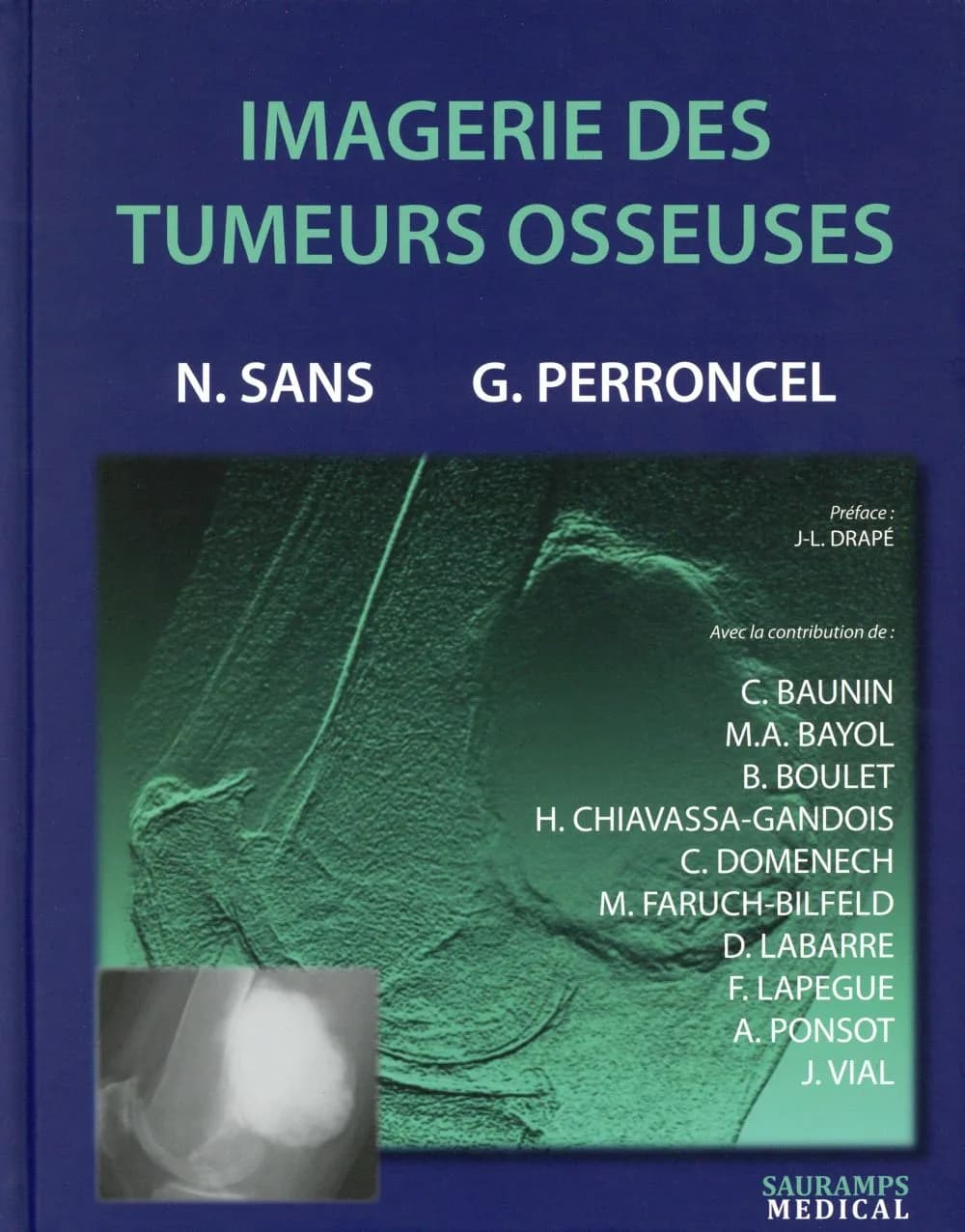 Imagerie des tumeurs osseuses
