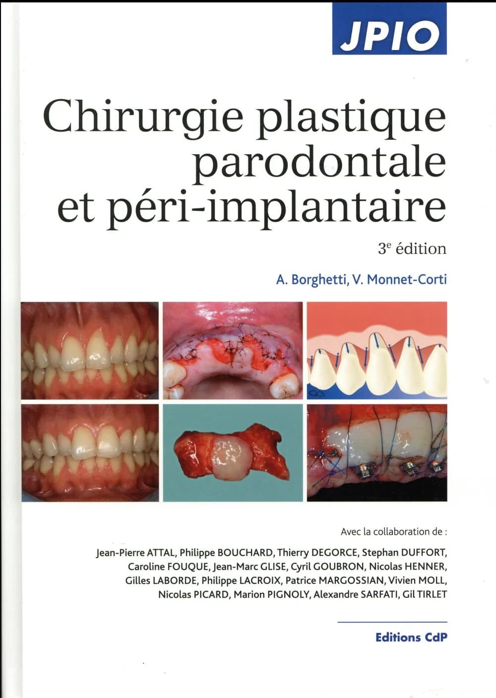Chirurgie plastique parodontale et péri-implantaire (3e éd.) Alain Borghetti et Virginie Monnet-Corti ; avec la collaboration de Jean-Pierre Attal, Philippe Bouchard, Thierry Degorce... [et al.]