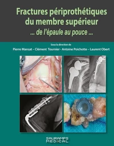 Fractures périprothétiques du membre supérieur : de l'épaule au pouce
