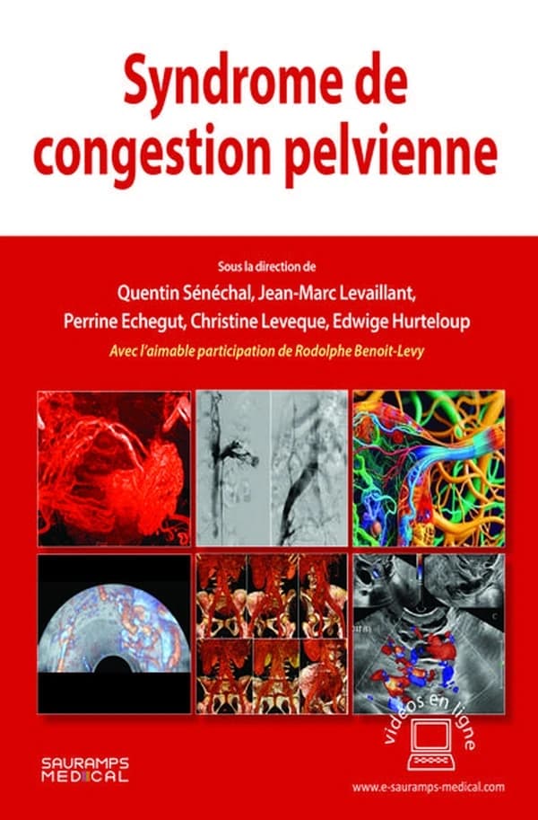 Syndrome de congestion pelvienne