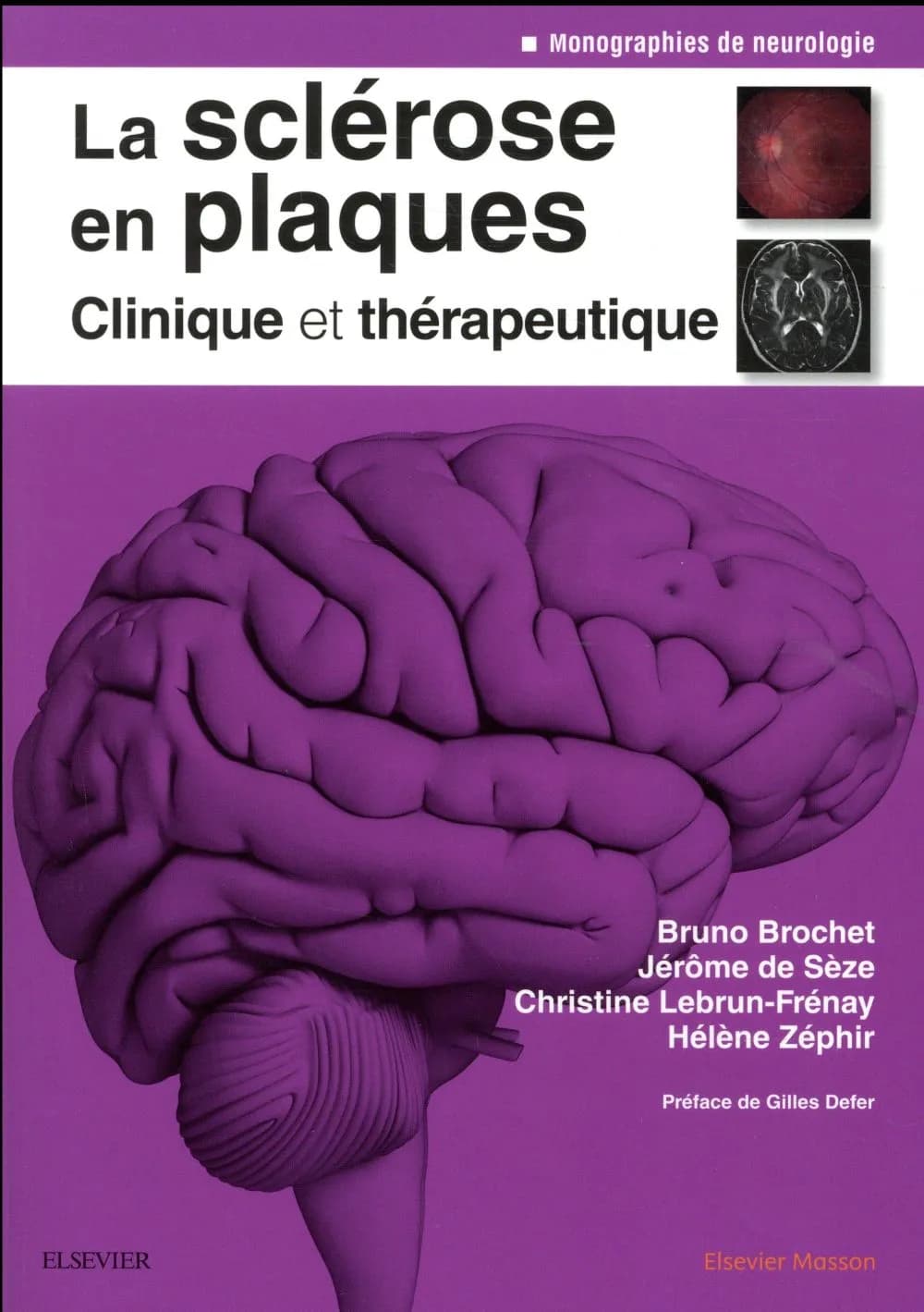 La sclérose en plaques : clinique et thérapeutique