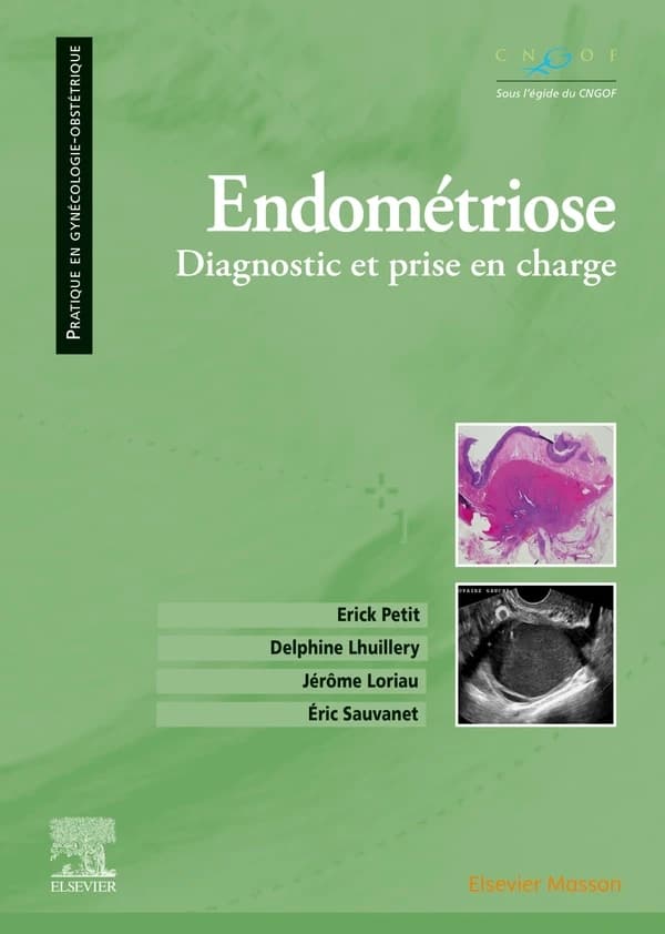 Endométriose : diagnotic et prise en charge