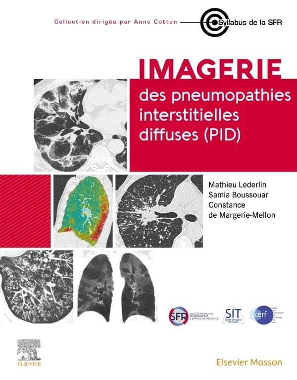 Imagerie des pneumopathies interstitielles diffuses, PID