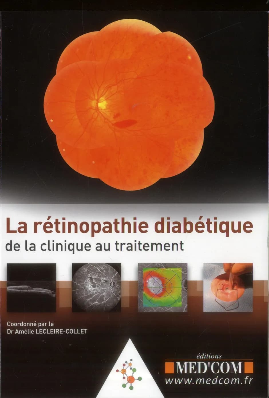La rétinopathie diabétique : de la clinique au traitement