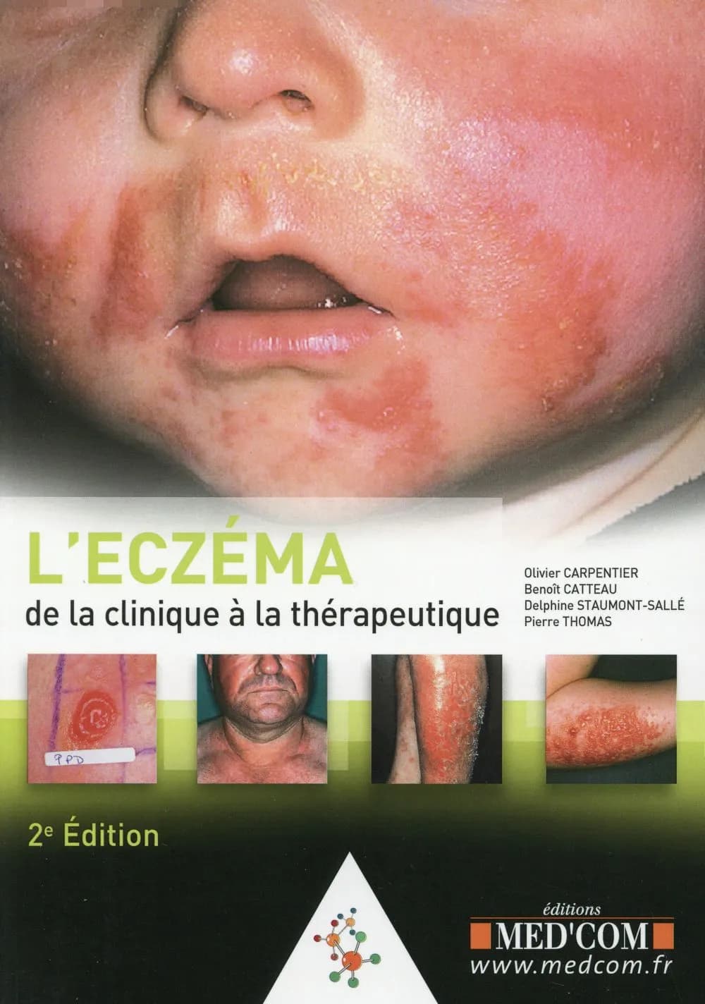 L'eczéma : de la clinique à la thérapeutique (2e éd.) Dr Olivier Carpentier,... Dr Benoît Catteau,... Pr Delphine Staumont-Sallé,... [et al.]