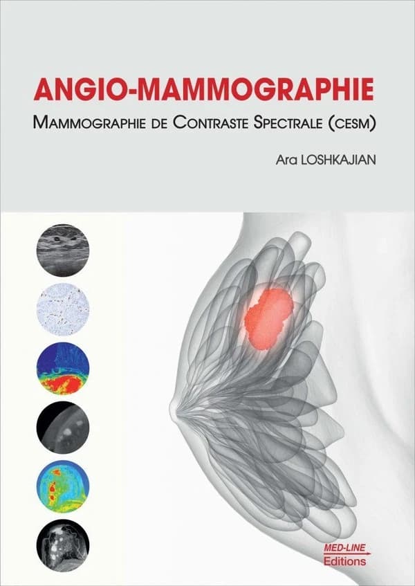 Angio-mammographie : mammographie de contraste spectrale (CESM)