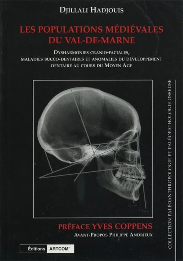 Les populations médiévales du Val-de-Marne : dysharmonies cranio-faciales, maladies bucco-dentaires et anomalies du développement dentaire au cours du Moyen âge