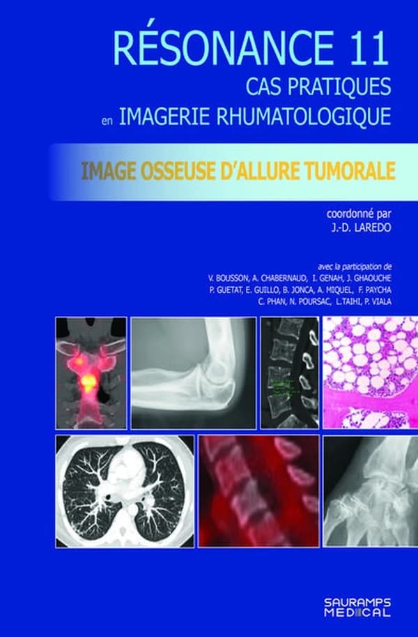 Images osseuse d'allure tumorale, analyse et conduite à tenir