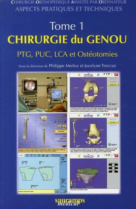 Chirurgie orthopédique assistée par ordinateur : aspects pratiques et techniques. Tome I, Chirurgie du genou, PTG, PUC, LCA et ostéotomies
