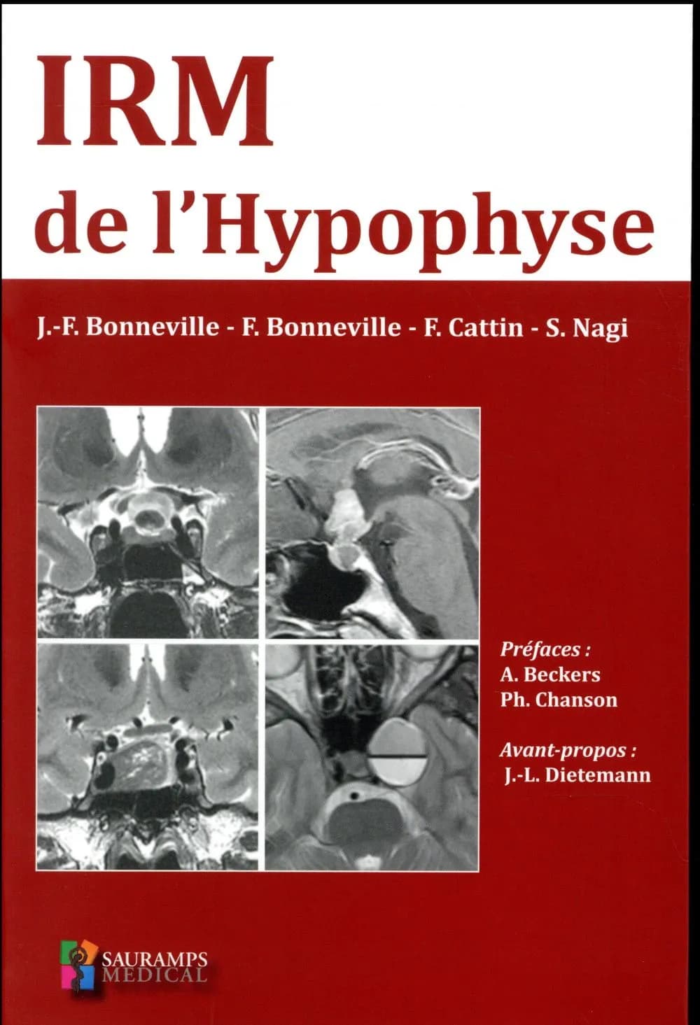 IRM de l'hypophyse